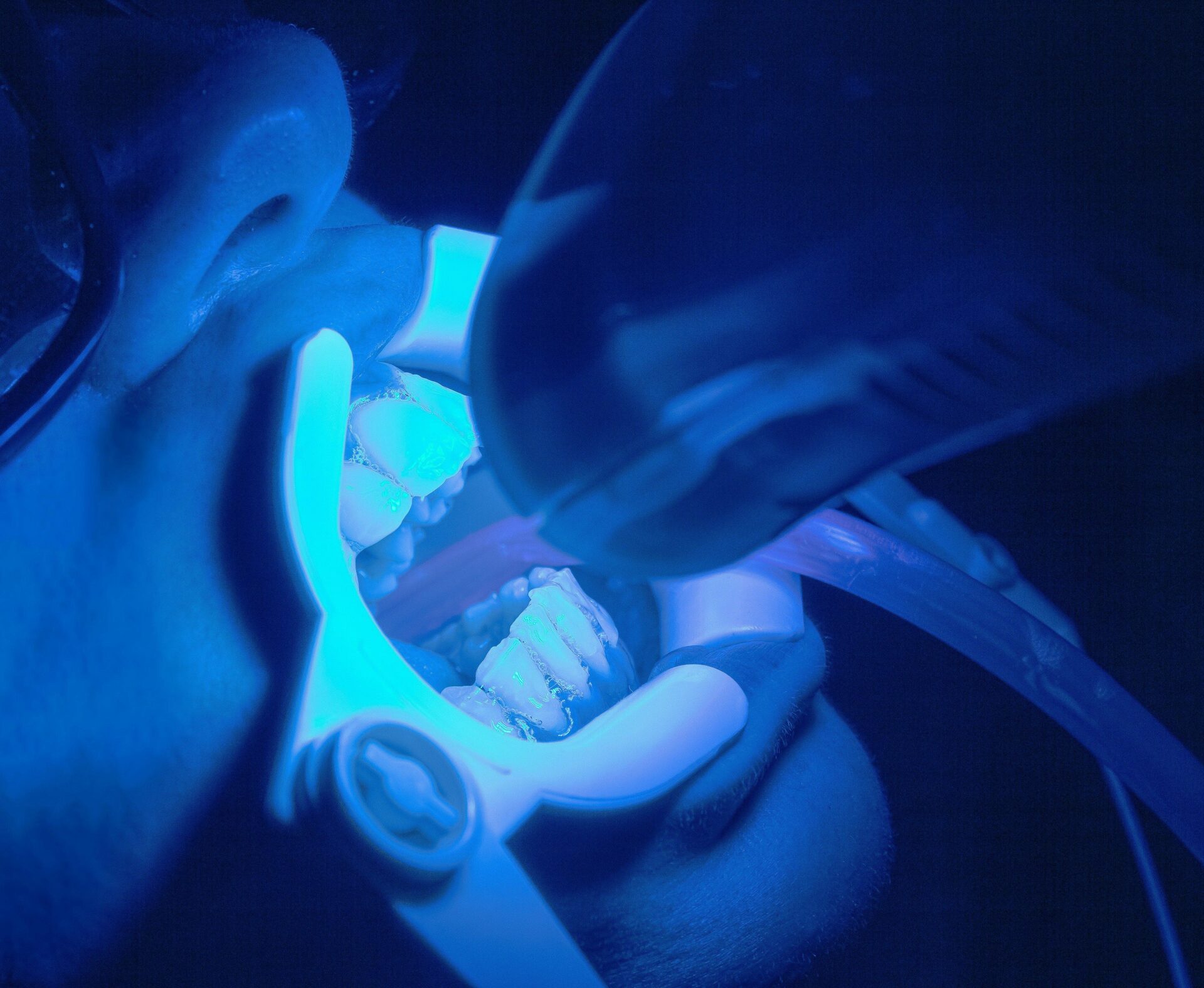 Dental Intraoral X-rays