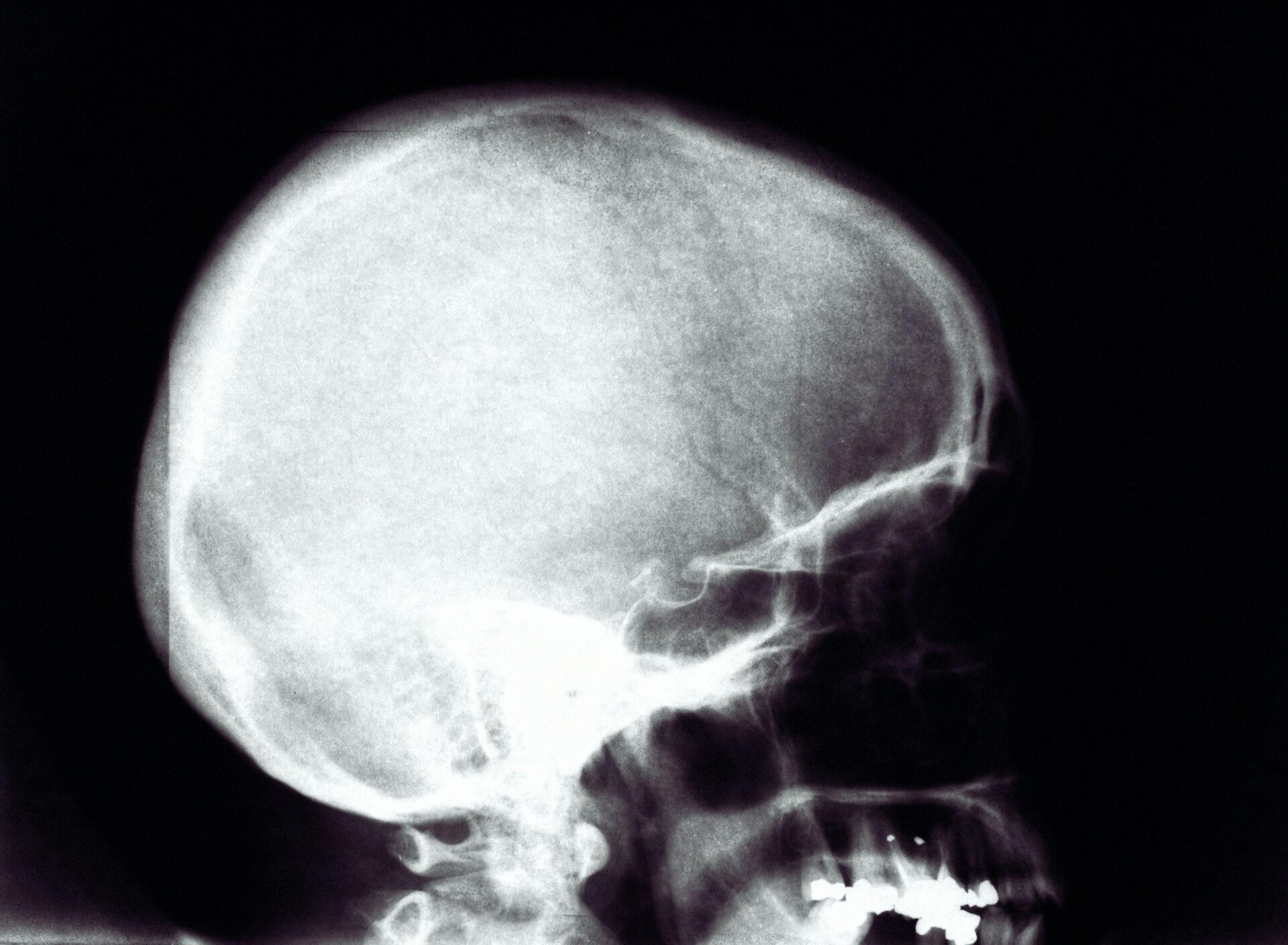 X-Ray Digitizers